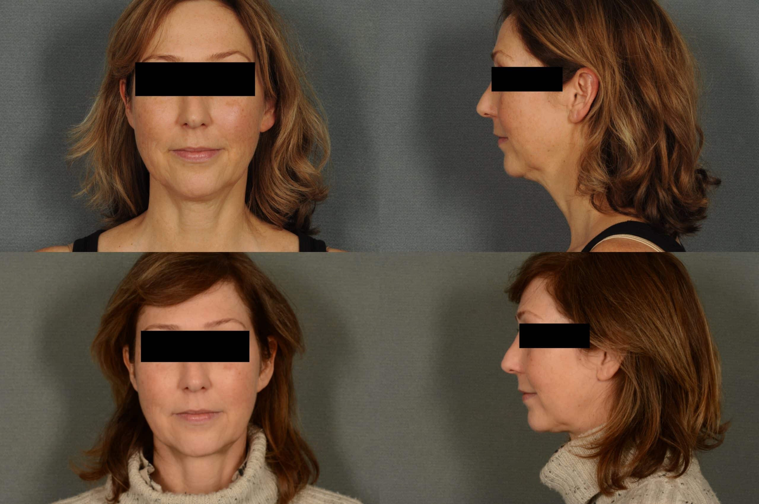 Neck Lift Case# 946 Combined Image
