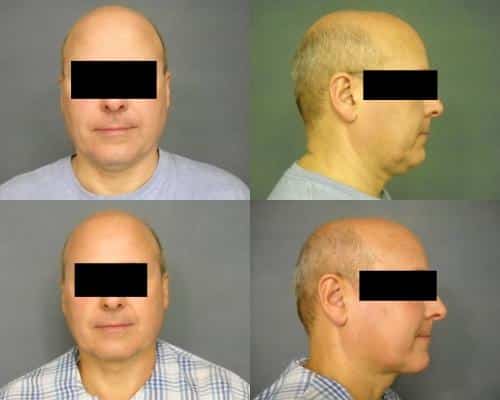 Liposuction Case #304 Combined Image