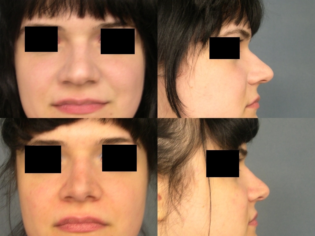 Rhinoplasty Case# 315 Combined Image
