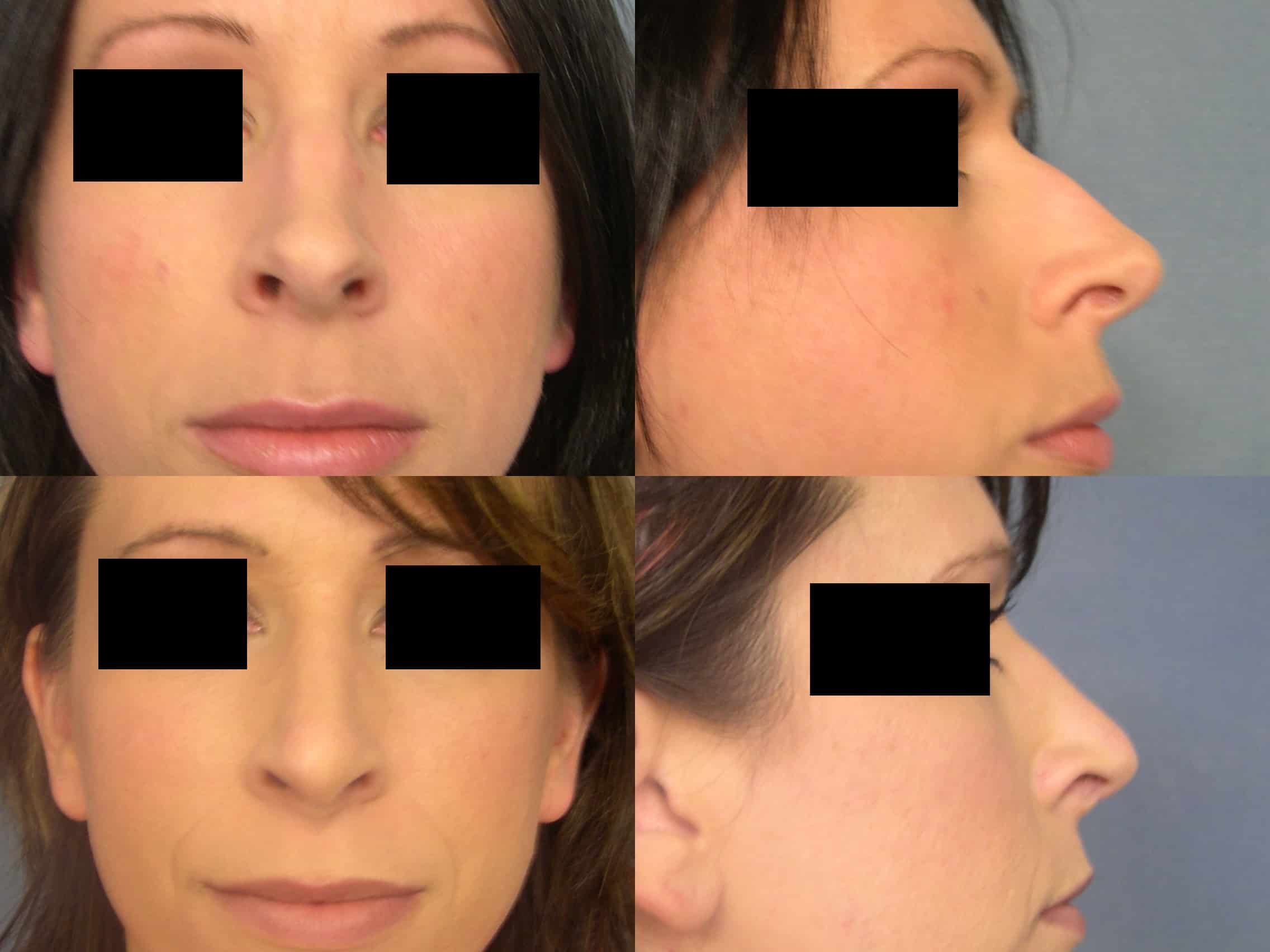 Rhinoplasty Case# 316 Combined Image