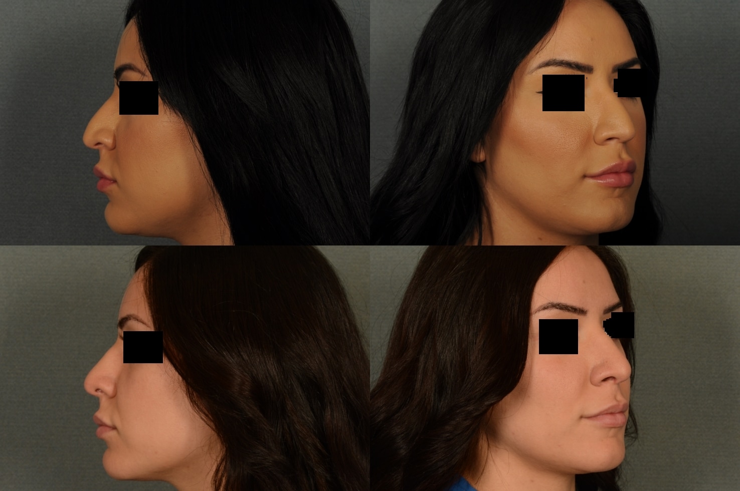 Rhinoplasty Case# 933 Combined Image