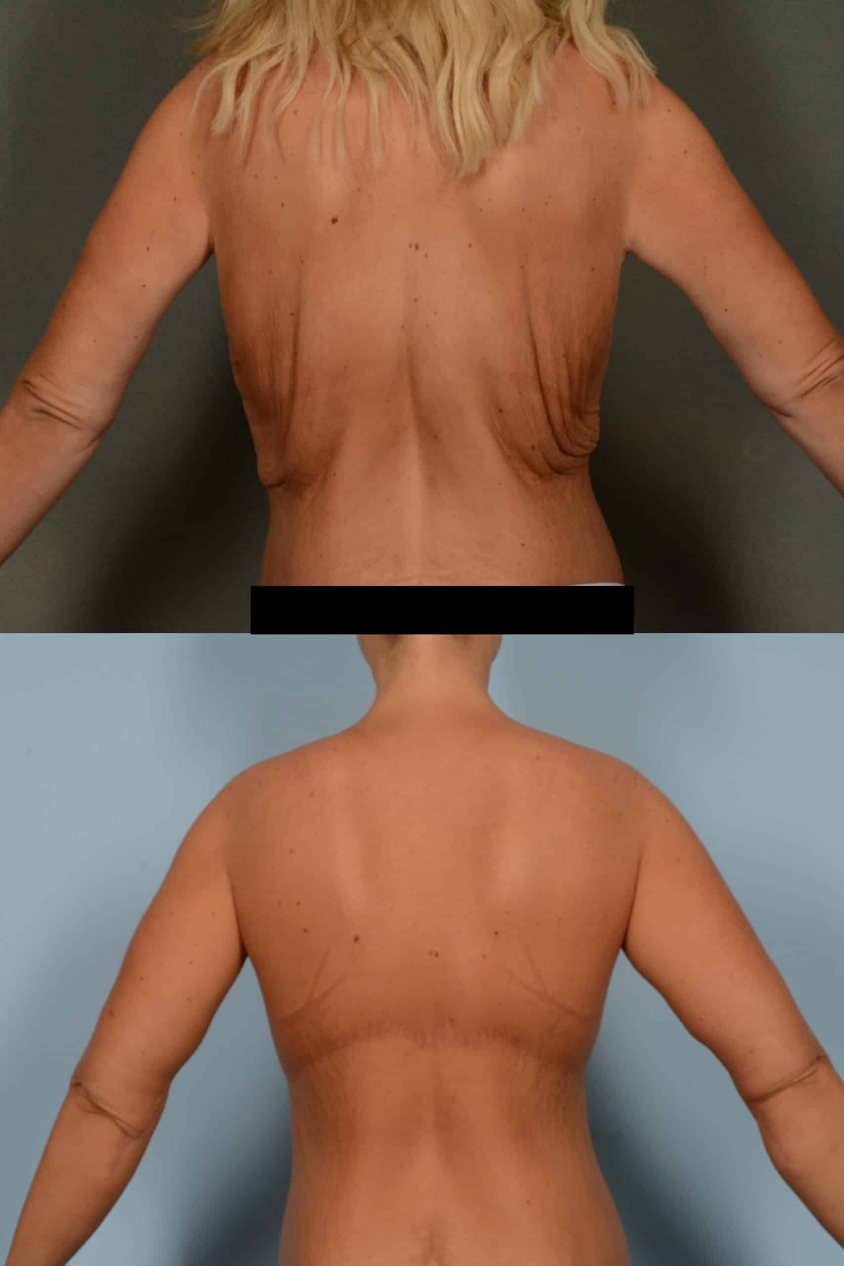 Back Lift Case# 1132 Combined Image