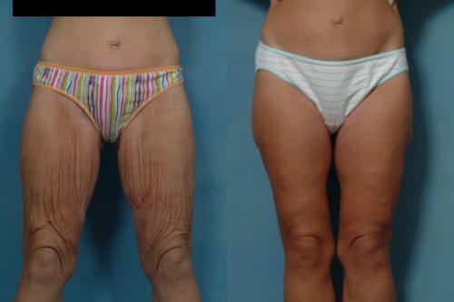 Thigh Lift Case #154 Combined Image
