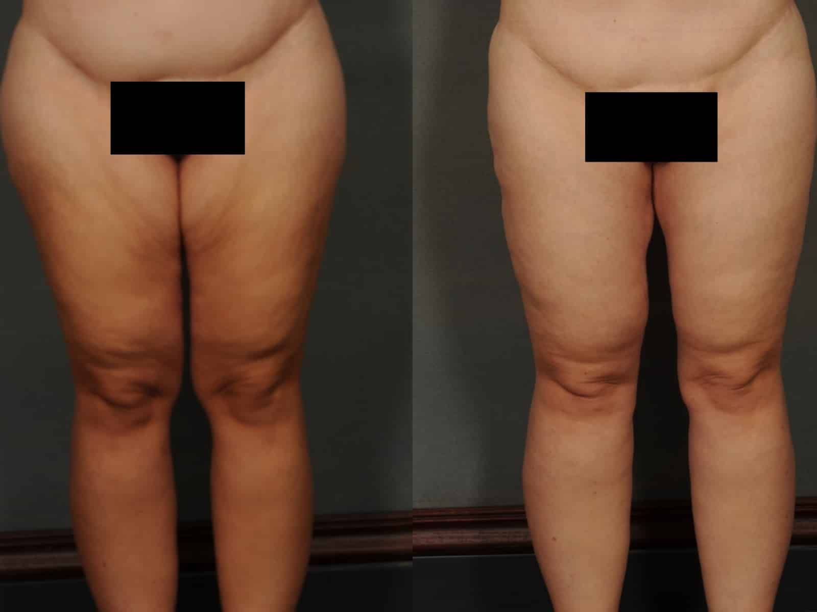 Thigh Lift Case# 843 Combined Image