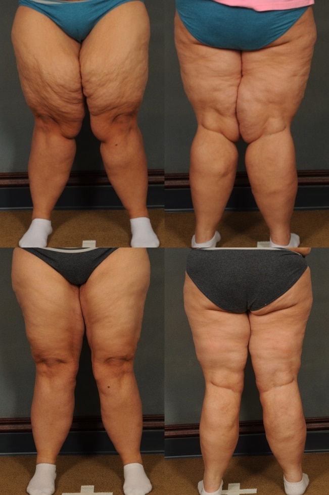 Thigh Lift Case# 863 Combined Image