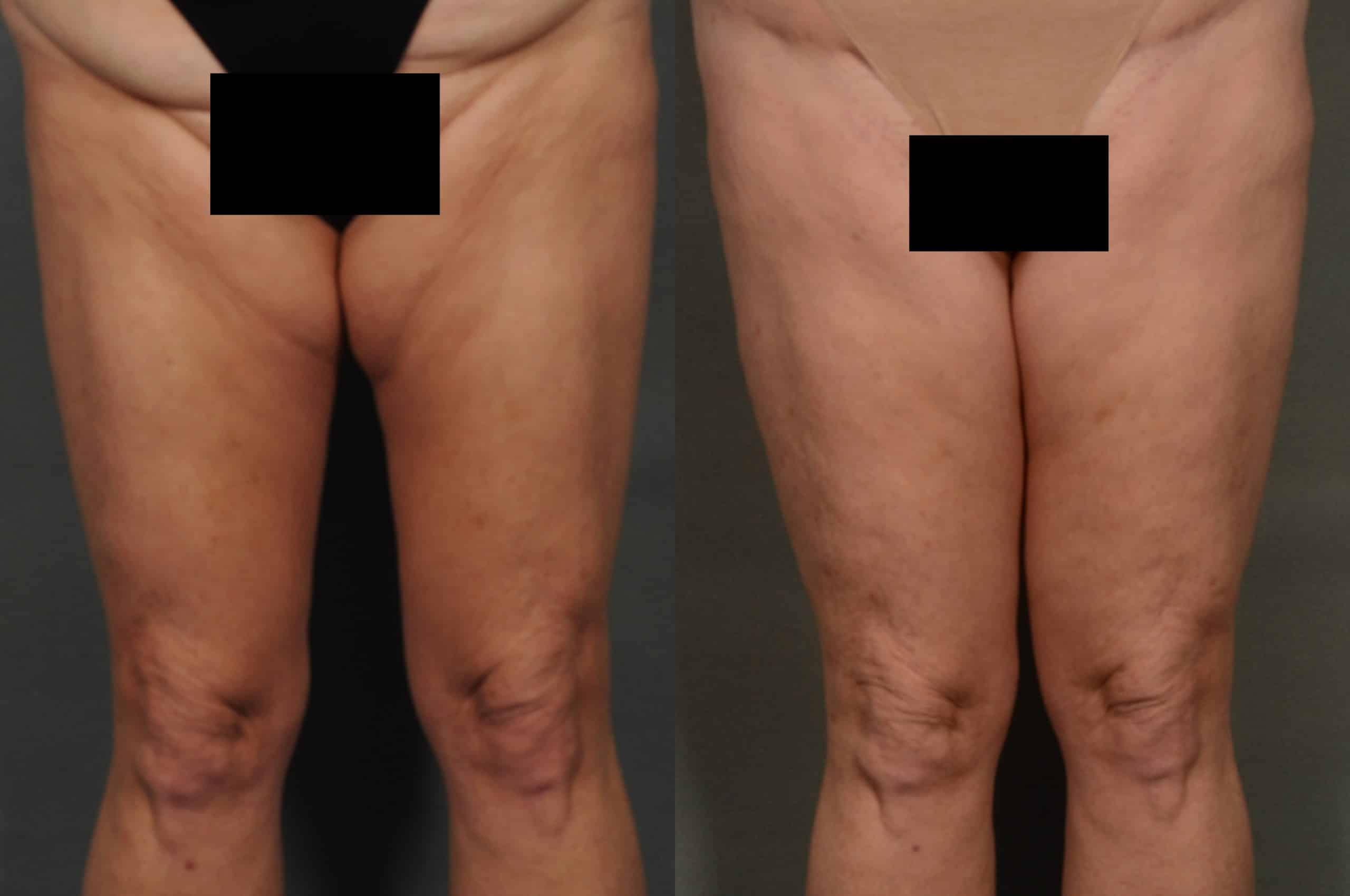 Thigh Lift Case# 905 Combined Image