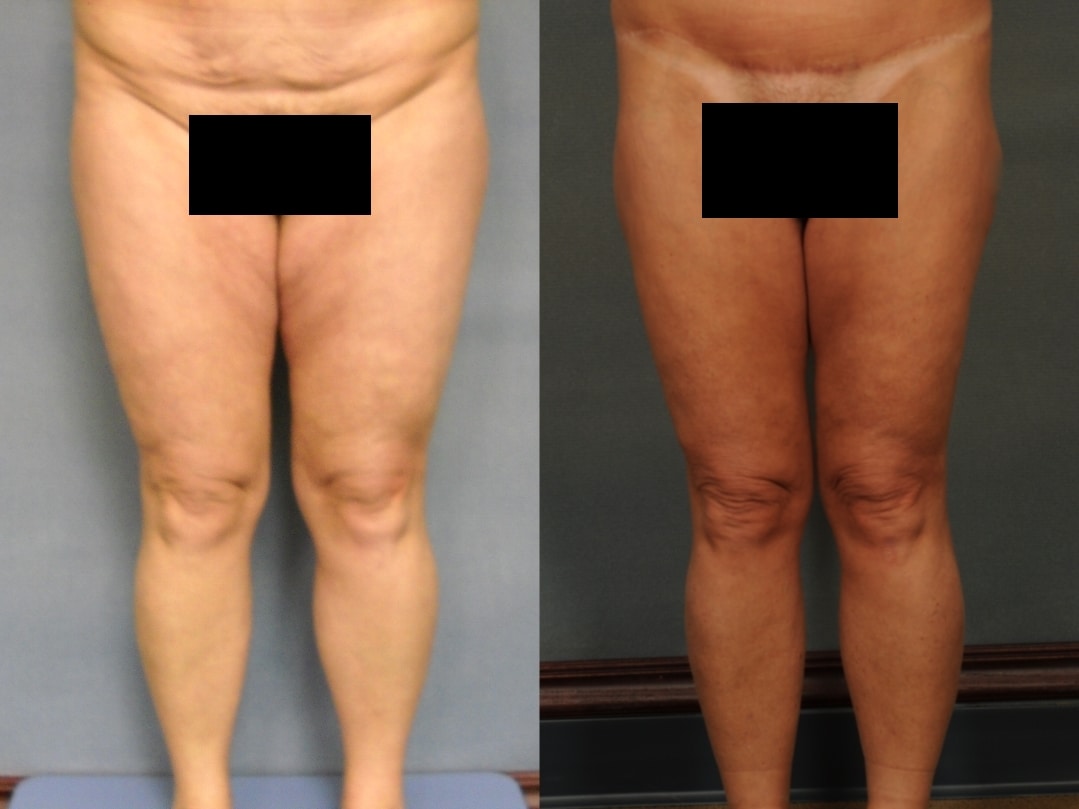 ThighLift Case# 765 Combined Image