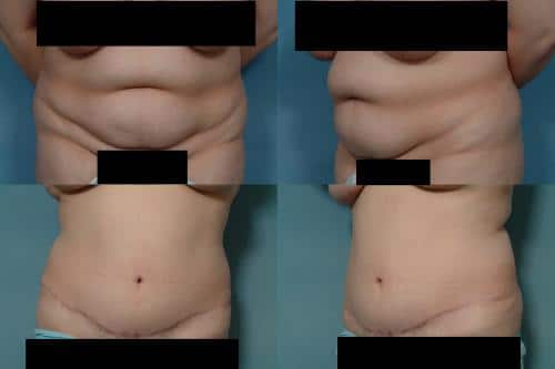 Tummy Tuck Case #101 Combined Image