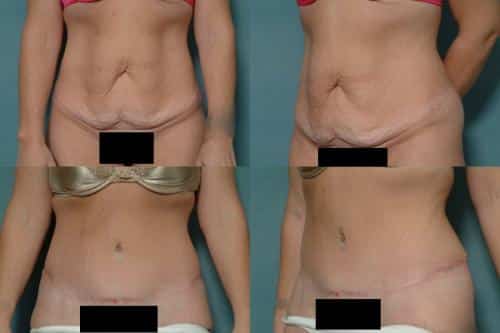 Tummy Tuck Case #102 Combined Image