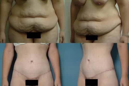 Tummy Tuck Case #103 Combined Image