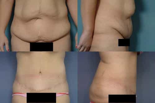 Tummy Tuck Case #104 Combined Image