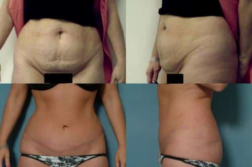 Tummy Tuck Case #105 Combined Image