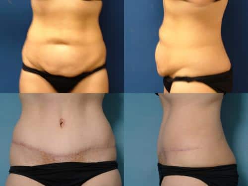 Tummy Tuck Case #106 Combined Image
