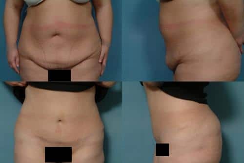 Tummy Tuck Case #107 Combined Image