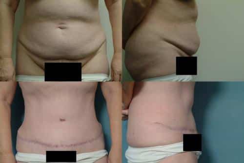 Tummy Tuck Case #108 Combined Image