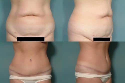 Tummy Tuck Case #110 Combined Image