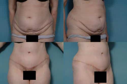 Tummy Tuck Case #161 Combined Image
