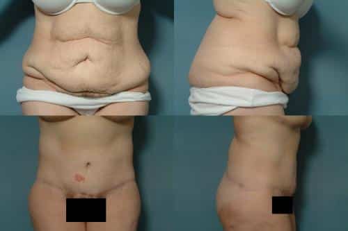Tummy Tuck Case #163 Combined Image