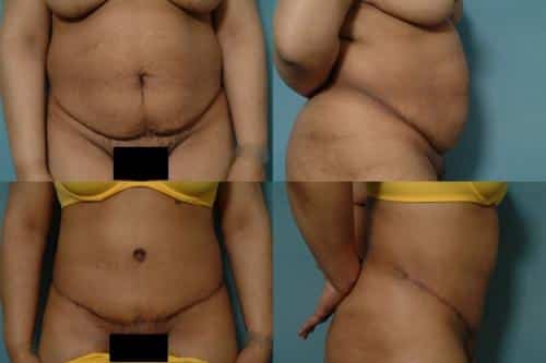 Tummy Tuck Case #164 Combined Image