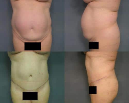 Tummy Tuck Case #165 Combined Image