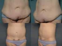 Tummy Tuck Case #191 Combined Image