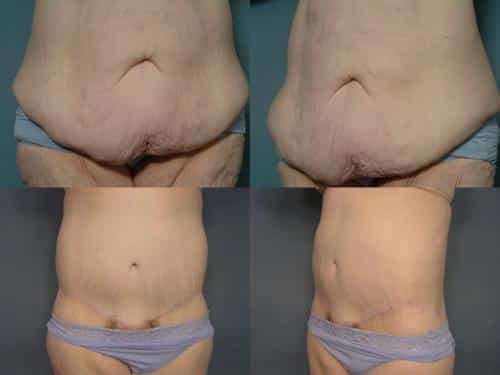 Tummy Tuck Case #191 Combined Image