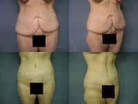 Tummy Tuck Case #192 Combined Image