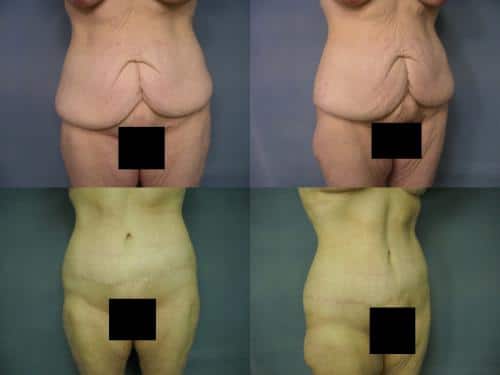 Tummy Tuck Case #192 Combined Image