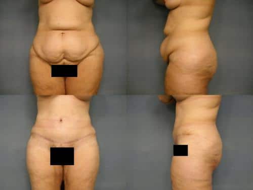 Tummy Tuck Case #194 Combined Image