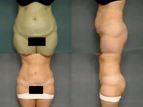 Tummy Tuck Case #204 Combined Image