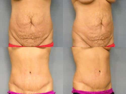 Tummy Tuck Case #217 Combined Image