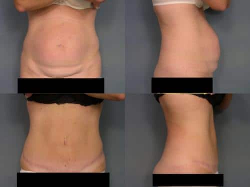 Tummy Tuck Case #218 Combined Image