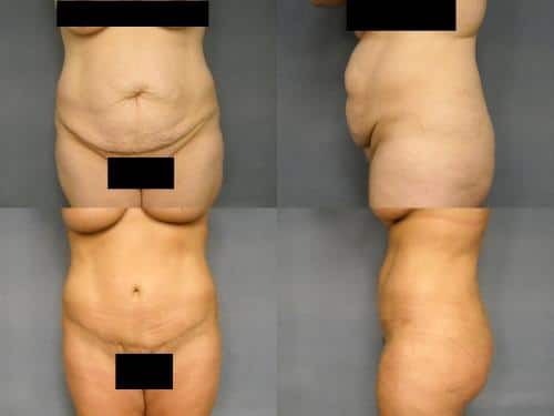 Tummy Tuck Case #221 Combined Image
