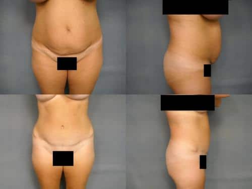 Tummy Tuck Case #226 Combined Image