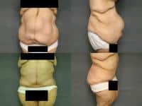 Tummy Tuck Case #240 Combined Image