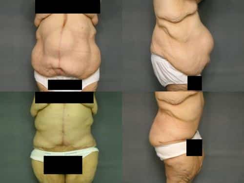 Tummy Tuck Case #240 Combined Image
