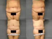 Tummy Tuck Case #242 Combined Image