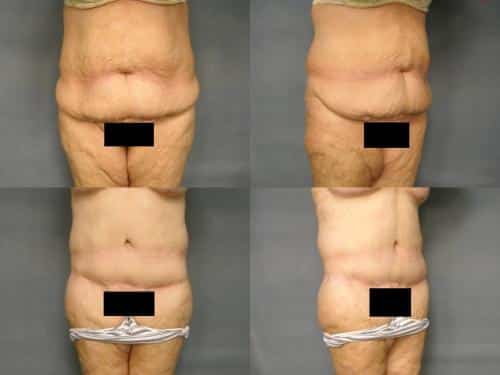 Tummy Tuck Case #242 Combined Image