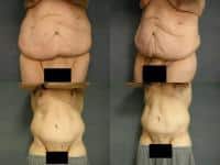 Tummy Tuck Case #253 Combined Image