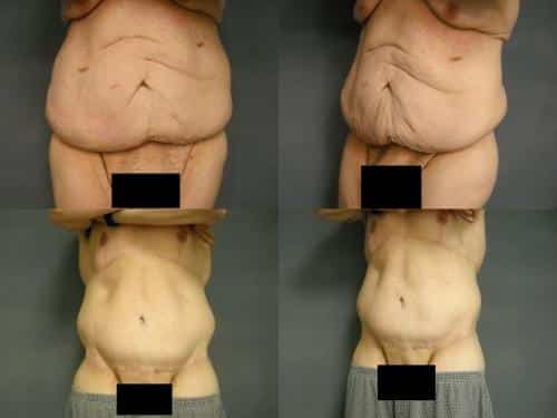 Tummy Tuck Case #253 Combined Image