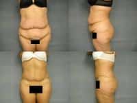 Tummy Tuck Case #260 Combined Image