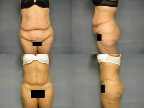 Tummy Tuck Case #260 Combined Image