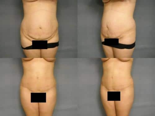 Tummy Tuck Case #263 Combined Image