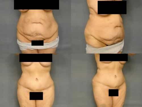 Tummy Tuck Case #272 Combined Image