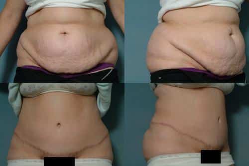Tummy Tuck Case #276 Combined Image
