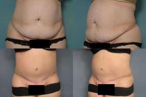 Tummy Tuck Case #277 Combined Image