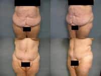 Tummy Tuck Case #278 Combined Image