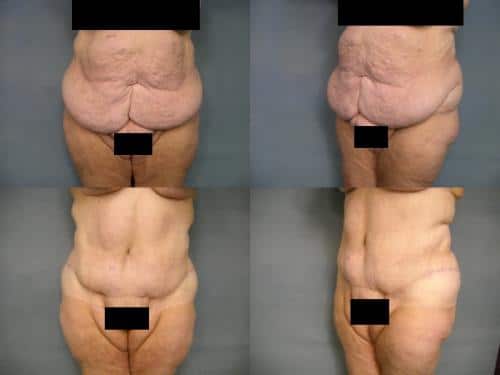 Tummy Tuck Case #278 Combined Image