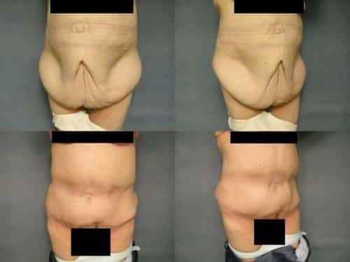 Tummy Tuck Case #279 Combined Image