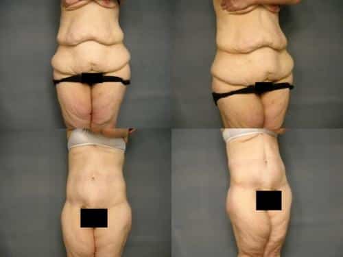 Tummy Tuck Case #283 Combined Image
